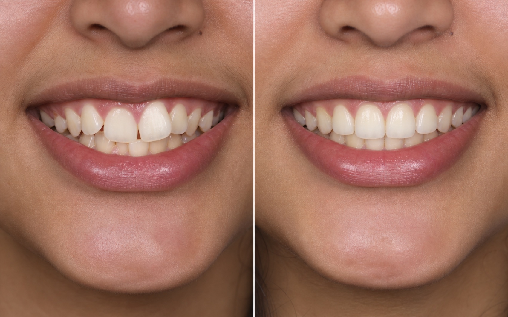 Illustrative before and after teeth alignment result