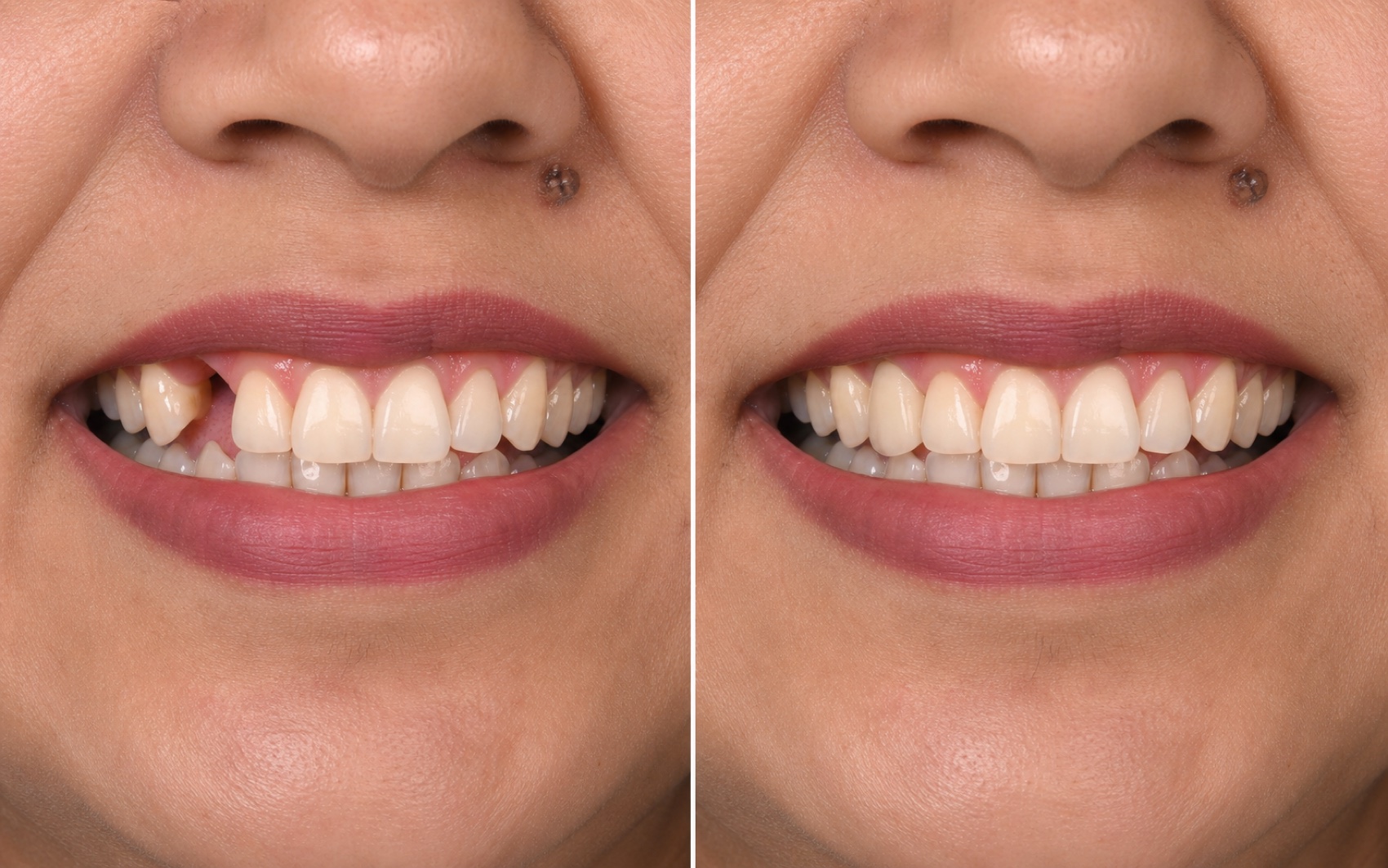 Illustrative before and after missing tooth replacement result
