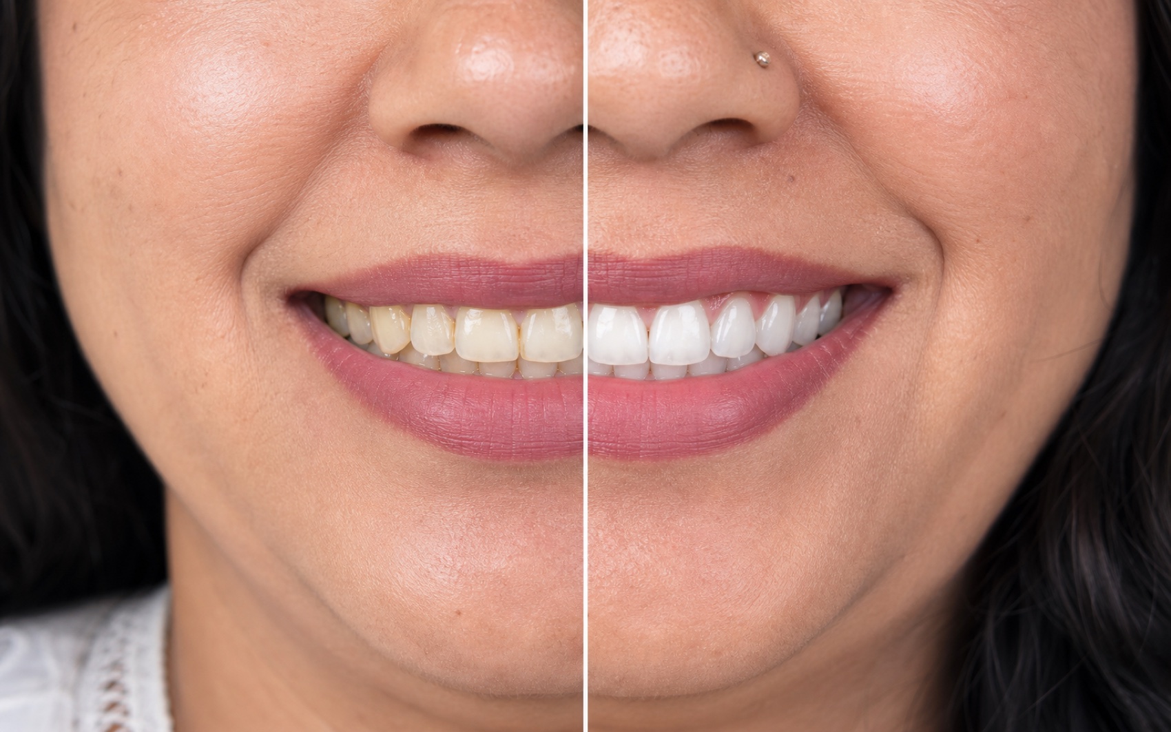 Illustrative before and after teeth whitening result